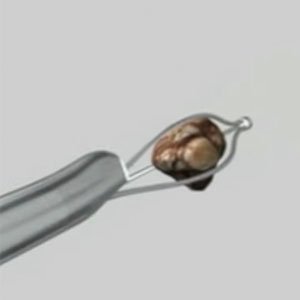 endoscopia semirrigida à laser
